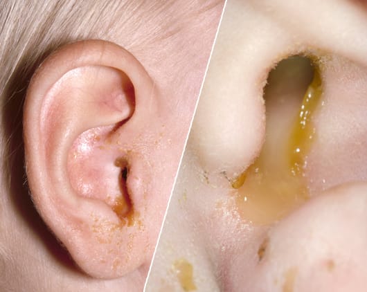 Ear Drainage in Adults - Causes, Symptoms, and Treatment