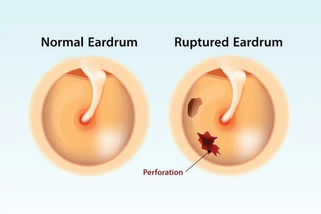 Middle Ear Infection and a Ruptured Eardrum